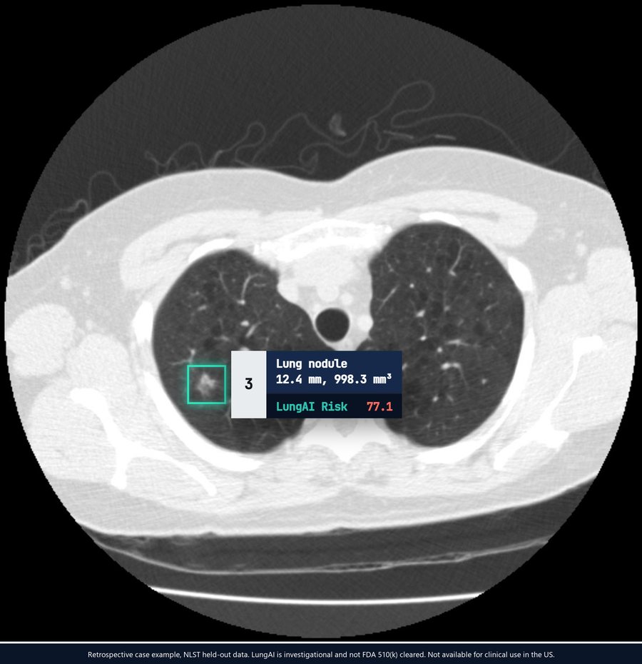 LungAI case example on a Lung-RADS 3 nodule