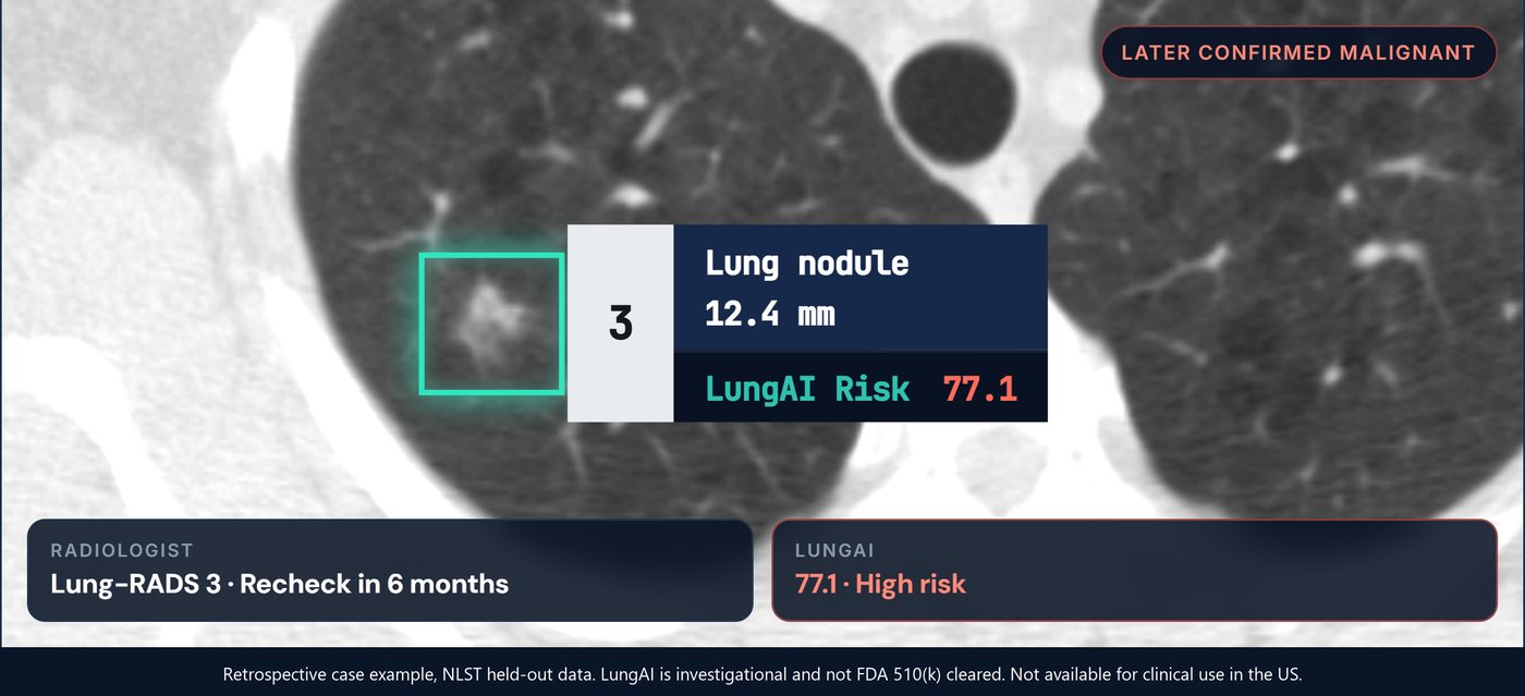 LungAI score on a lung nodule in a CT scan